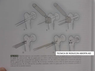 TECNICA DE REDUCCIN ABIERTA AO
 