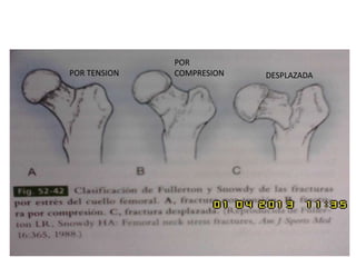 POR TENSION
POR
COMPRESION DESPLAZADA
 