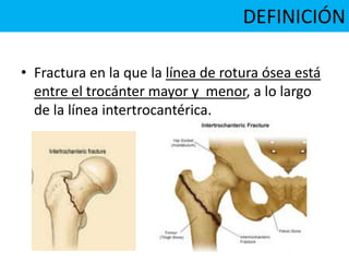 DEFINICIÓN
• Fractura en la que la línea de rotura ósea está
entre el trocánter mayor y menor, a lo largo
de la línea intertrocantérica.
 