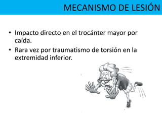 • Impacto directo en el trocánter mayor por
caída.
• Rara vez por traumatismo de torsión en la
extremidad inferior.
MECANISMO DE LESIÓN
 