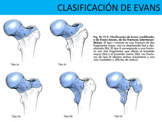 CLASIFICACIÓN DE EVANS
 