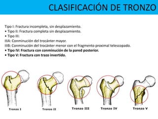 CLASIFICACIÓN DE TRONZO
Tipo I: Fractura incompleta, sin desplazamiento.
• Tipo II: Fractura completa sin desplazamiento.
• Tipo III:
IIIA: Conminución del trocánter mayor.
IIIB: Conminución del trocánter menor con el fragmento proximal telescopado.
• Tipo IV: Fractura con conminución de la pared posterior.
• Tipo V: Fractura con trazo invertido.
 