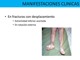 • En fracturas con desplazamiento
• Extremidad inferior acortada
• En rotación externa
MANIFESTACIONES CLINICAS
 