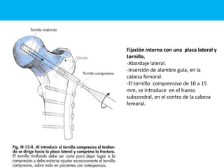 Fijación interna con una placa lateral y
tornillo.
-Abordaje lateral.
-Inserción de alambre guía, en la
cabeza femoral.
-El tornillo comprensivo de 10 a 15
mm, se introduce en el hueso
subcondral, en el centro de la cabeza
femoral.
 