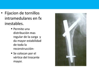 • Fijacion de tornillos
intramedulares en fx
inestables.
 Permite una
distribución mas
regular de la carga y
da mayor estabilidad
de toda la
reconstrucción-
 Se colocan por el
vértice del trocante
mayor.
 