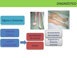 Signos y Sintomas
Historia
Clinica
Lesión
Desplazada DOLOR
DEFORMIDAD
DEL MUSLO
Acortamiento
del miembro
Angulación y
Rotación
anormal
DIAGNÓSTICO
 