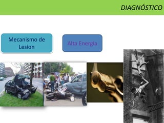 Mecanismo de
Lesion
Alta Energía
DIAGNÓSTICO
 