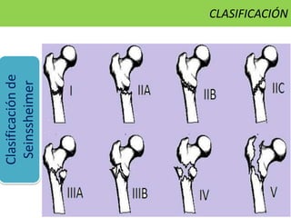 Clasificaciónde
Seinssheimer
CLASIFICACIÓN
 