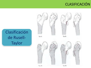 Clasificación
de Rusell-
Taylor
CLASIFICACIÓN
 