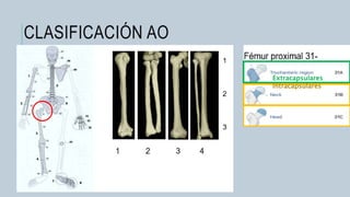 CLASIFICACIÓN AO
Extracapsulares
Intracapsulares
 