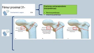 Fracturas extracapsulares
(trocantéricas)
• Pertrocantéreas
• Intertrocantéreas
 