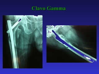 fracturas de cadera tipos, caracteristicas.pdf