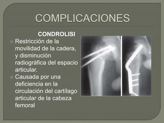 Fracturas de cadra pediatricas. | PPTX