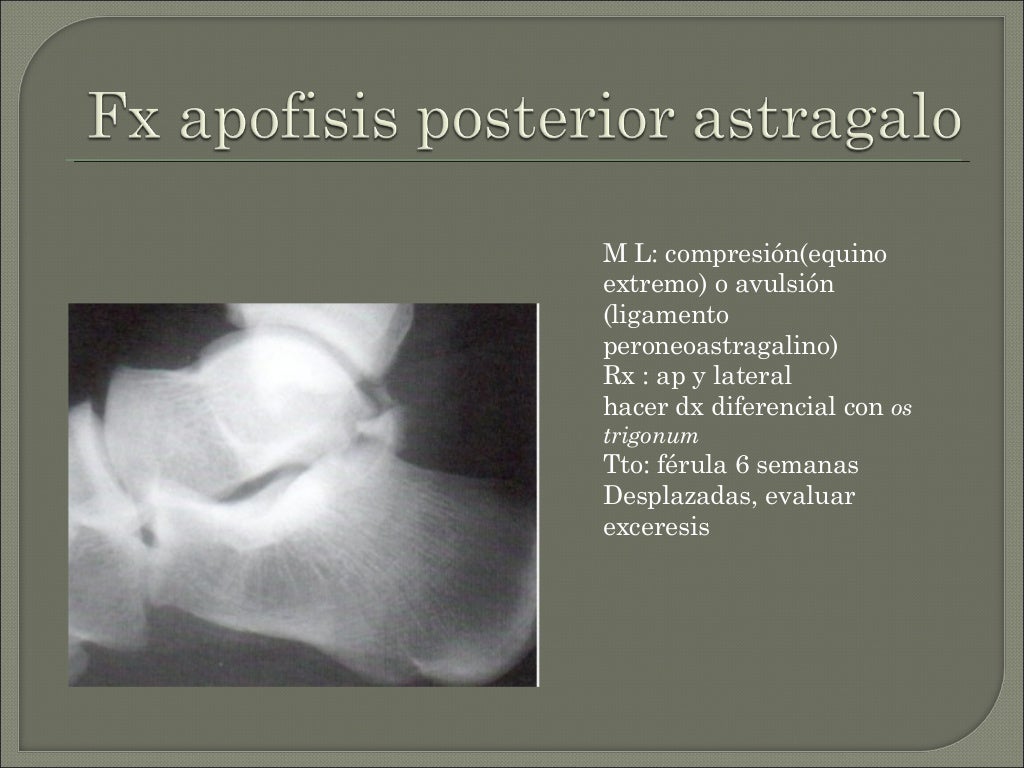 Fracturas de calcaneo y astragalo