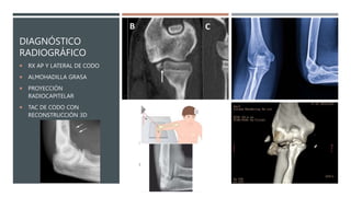 FRACTURAS DE RADIO Y CUBITO PROXIMAL CODO.pptx