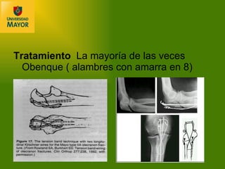 Tratamiento  La mayoría de las veces Obenque ( alambres con amarra en 8) 
