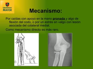 Mecanismo:   Por caídas con apoyo en la mano  pronada  y algo de flexión del codo, o por un estrés en valgo con lesión asociada del colateral medial.  Como mecanismo directo es más raro. 