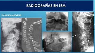 FRACTURAS DE COLUMNA VERTEBRAL EN ORTOPEDIA.pptx