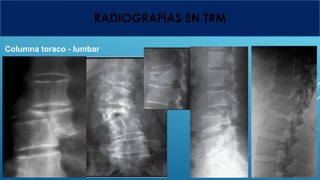 FRACTURAS DE COLUMNA VERTEBRAL EN ORTOPEDIA.pptx