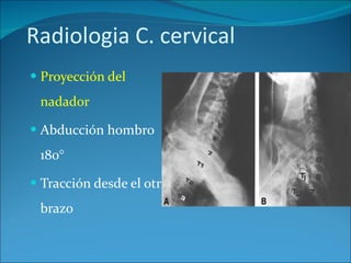 Radiologia C. cervical Proyección del nadador Abducción hombro 180° Tracción desde el otro brazo 