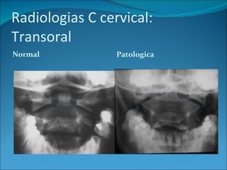 Radiologias C cervical: Transoral Normal Patologica 