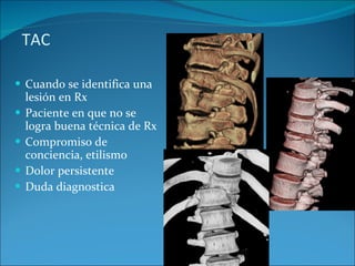 TAC  Cuando se identifica una lesión en Rx Paciente en que no se logra buena técnica de Rx Compromiso de conciencia, etilismo Dolor persistente  Duda diagnostica 
