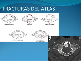 FRACTURAS DEL ATLAS 