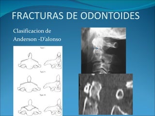 FRACTURAS DE ODONTOIDES Clasificacion de Anderson -D’alonso 