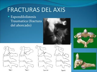 FRACTURAS DEL AXIS Espondilolistesis Traumatica (fractura del ahorcado) 