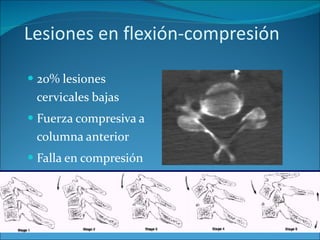Lesiones en flexión-compresión 20% lesiones cervicales bajas Fuerza compresiva a columna anterior Falla en compresión de columna anterior 