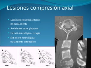 Lesiones compresión axial Lesion de columna anterior principalmente Accidentes auto, piqueros Déficit neurológico: cirugía Sin lesión neurológica: tratamiento ortopédico 