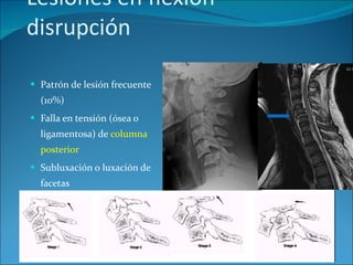 Lesiones en flexión-disrupción Patrón de lesión frecuente (10%) Falla en tensión (ósea o ligamentosa) de  columna posterior Subluxación o luxación de facetas 