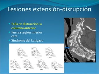Lesiones extensión-disrupción Falla en distracción la columna anterior Fuerza región inferior cara  Sindrome del Latigazo 
