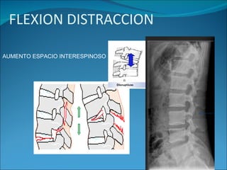 AUMENTO ESPACIO INTERESPINOSO 