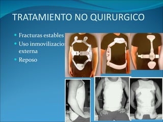 TRATAMIENTO NO QUIRURGICO Fracturas estables Uso inmovilizacion externa  Reposo 