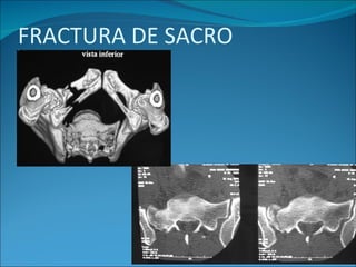 FRACTURA DE SACRO 