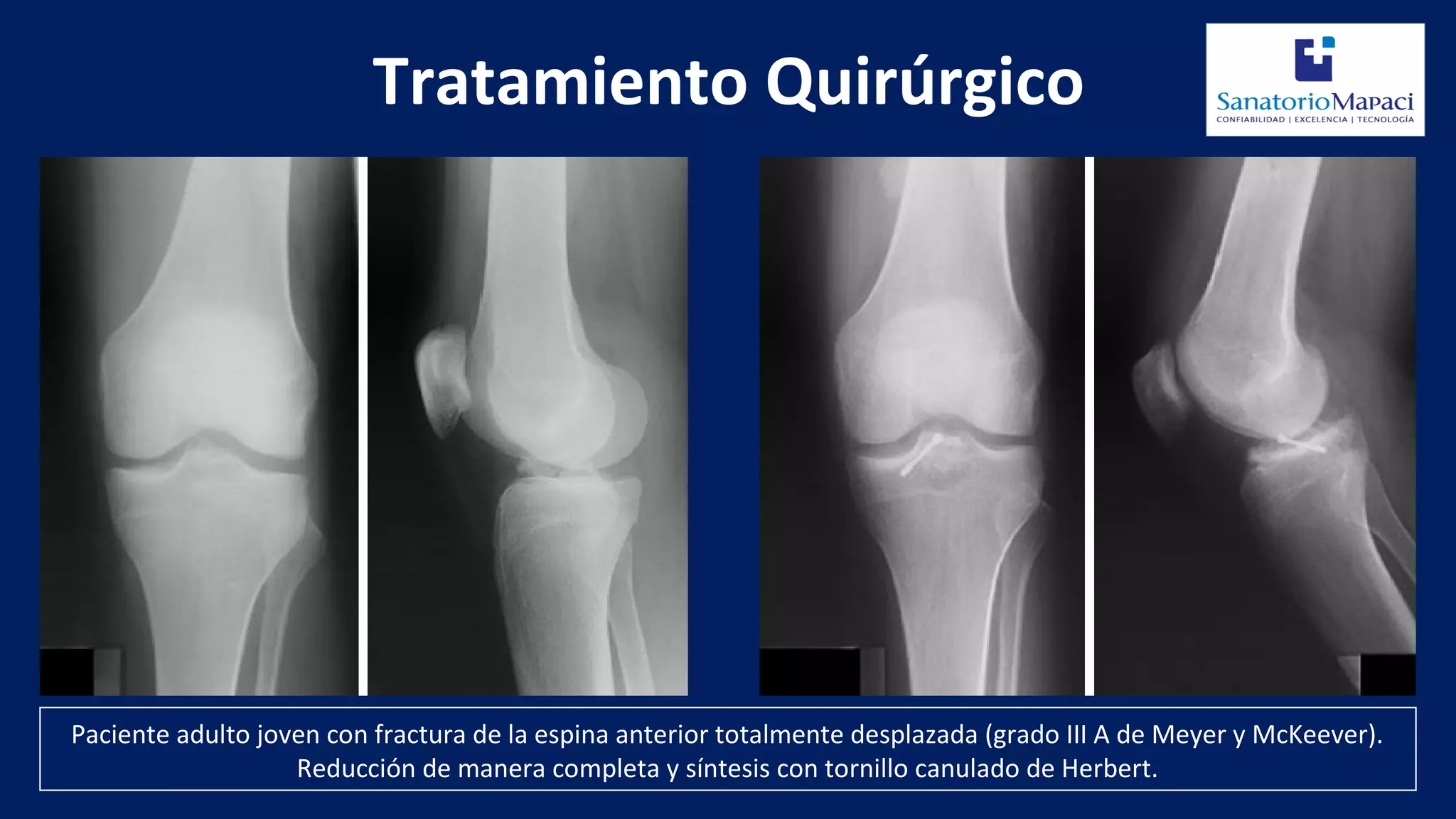 Fracturas de espina tibial | PPT