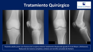 Tratamiento Quirúrgico
Paciente adulto joven con fractura de la espina anterior totalmente desplazada (grado III A de Meyer y McKeever).
Reducción de manera completa y síntesis con tornillo canulado de Herbert.
 