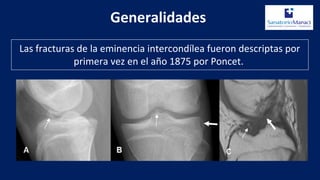 Las fracturas de la eminencia intercondílea fueron descriptas por
primera vez en el año 1875 por Poncet.
Generalidades
 