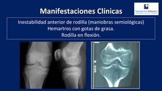 Manifestaciones Clínicas
Inestabilidad anterior de rodilla (maniobras semiológicas)
Hemartros con gotas de grasa.
Rodilla en flexión.
 