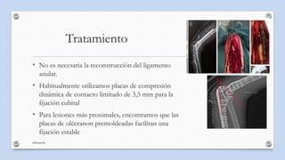 Tratamiento
• No es necesaria la reconstrucción del ligamento
anular.
• Habitualmente utilizamos placas de compresión
diná...