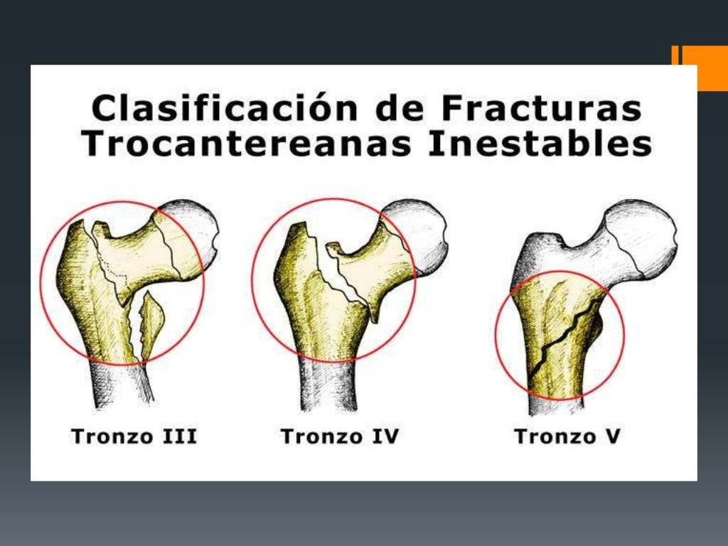 Fracturas De Femur Proximal