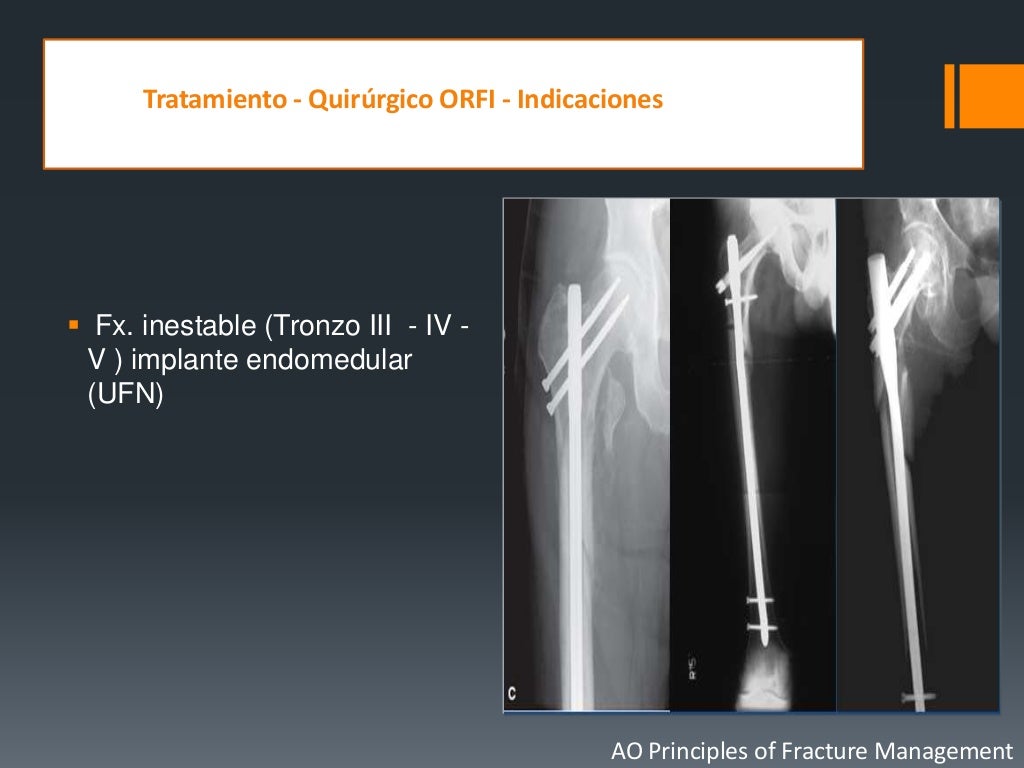 Fracturas De Femur Proximal