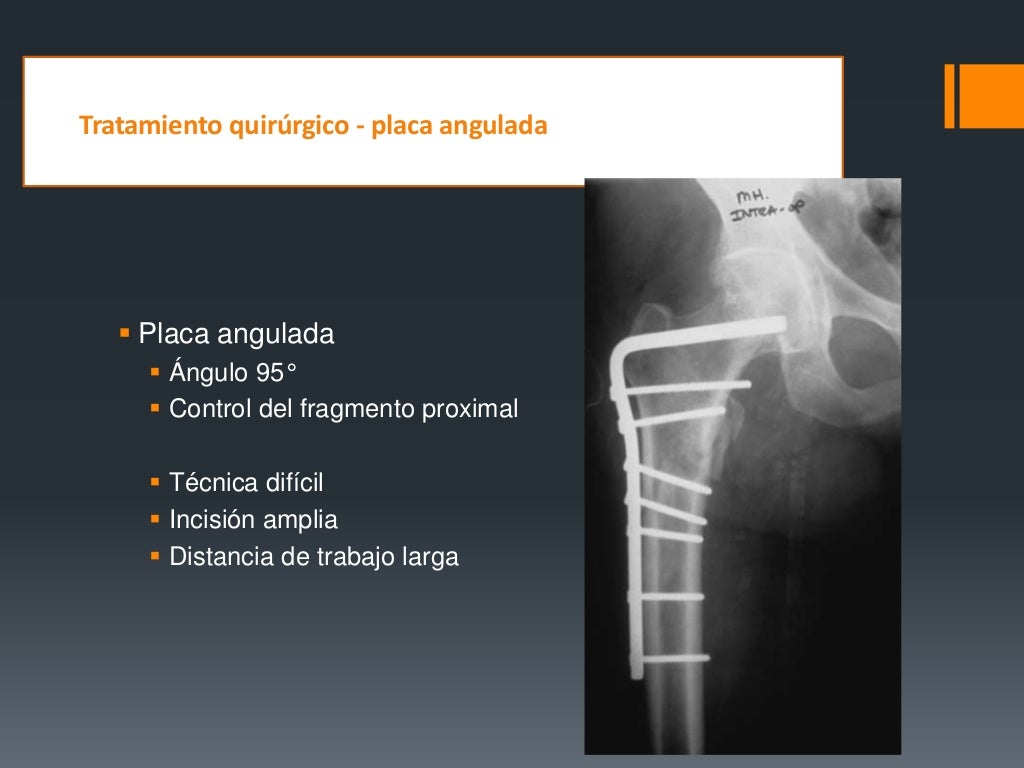 Fracturas De Femur Proximal
