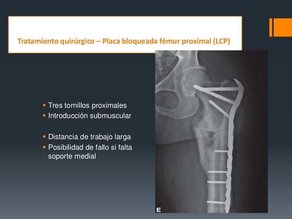 Fracturas De Femur Proximal Fracturas De Femur Proximal