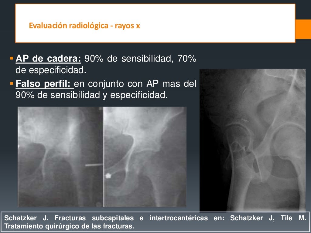 Fracturas De Femur Proximal