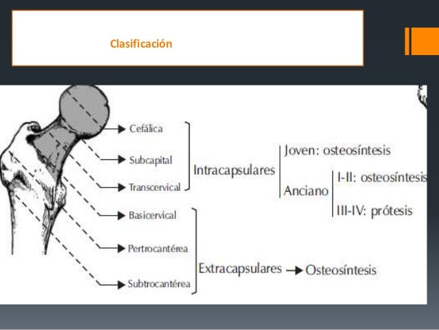 Fracturas De Femur Proximal
