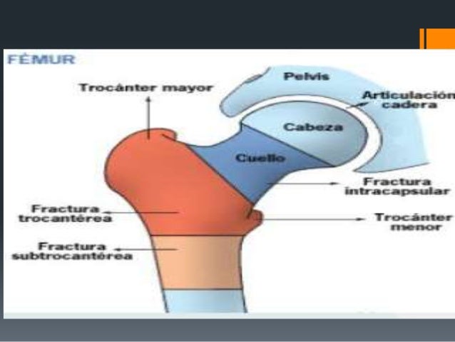Fracturas De Femur Proximal