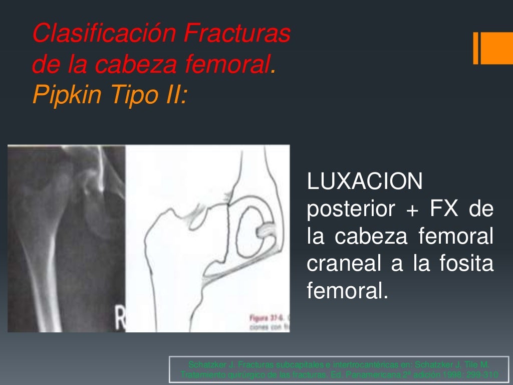 Fracturas De Femur Proximal