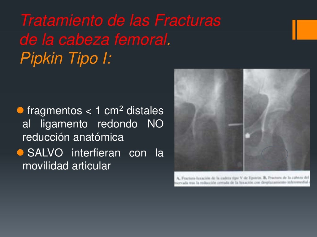 Fracturas De Femur Proximal